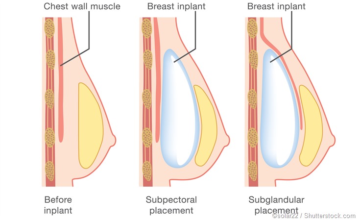 Breast implant surgery